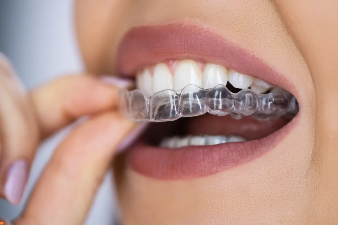 Misht Aligners packaging design